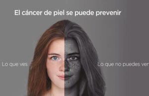 Melanoma: Un tumor que puede ser mortal